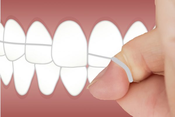 Five Effective Ways to Prevent Dental Cavities