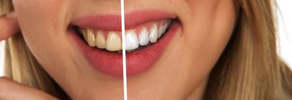LED Teeth Whitening Safe and Effective for Your Teeth