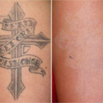 Tattoo Removal with Pico Laser in Singapore