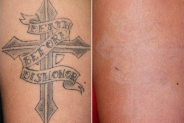 Tattoo Removal with Pico Laser
